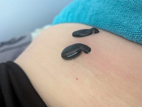 Medicinal leeches applied to the treatment area on a patient's skin during leech therapy